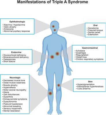 Very early and severe presentation of Triple A syndrome – case report and review of the literature